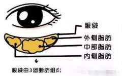 抽脂去眼袋后眼部皮膚會變得松弛？有什么辦法補救？