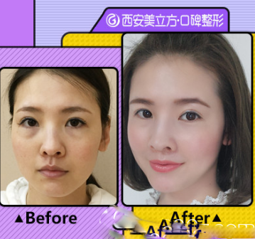 自體脂肪充盈例自體脂肪充盈例