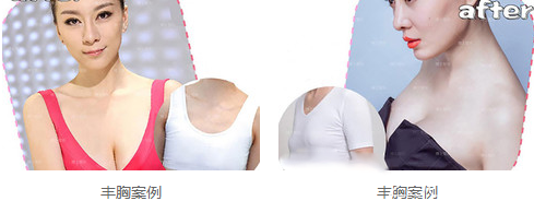 青島醫(yī)生整形外科醫(yī)院隆胸手術病例分析