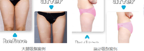吸脂病例