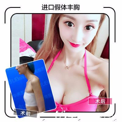 合肥華美趙輯假體隆胸前后對比照
