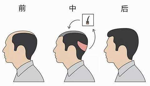 頭發(fā)種植還有這一些副作用！絕大部分醫(yī)生不可能對(duì)你說