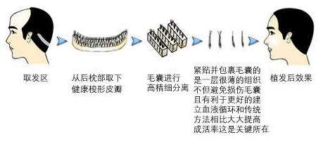 頭發(fā)種植還有這一些副作用！絕大部分醫(yī)生不可能對(duì)你說