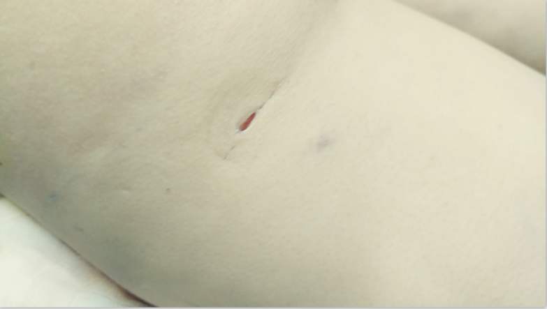 脂肪填充后的針眼疤痕，該怎樣清除？