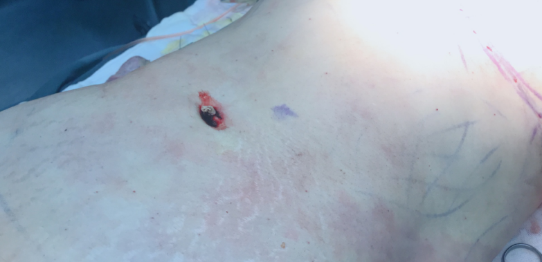 脂肪填充后的針眼疤痕，該怎樣清除？