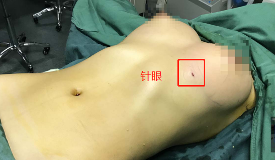 脂肪填充后的針眼疤痕，該怎樣清除？