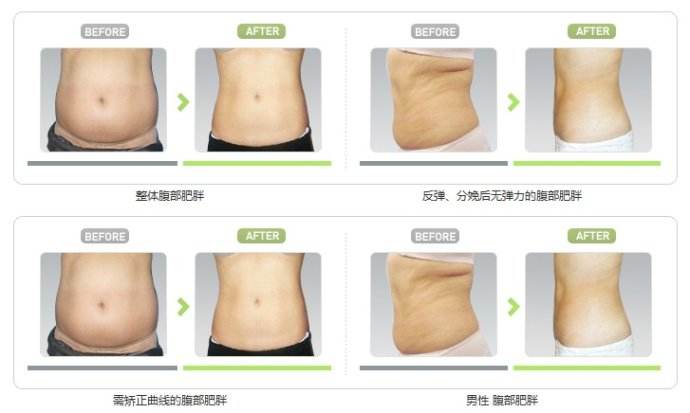 腰腹部環(huán)吸+大腿吸脂手術(shù)，讓人體會截然不同的你~