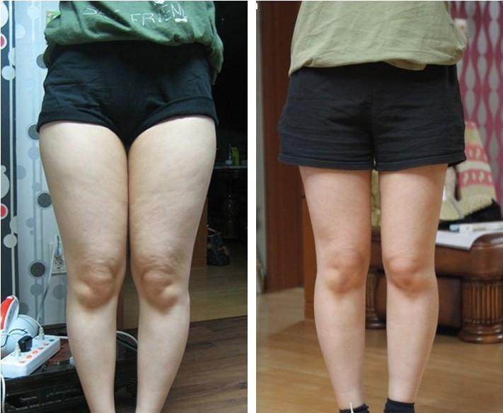 腰腹部環(huán)吸+大腿吸脂手術(shù)，讓人體會截然不同的你~