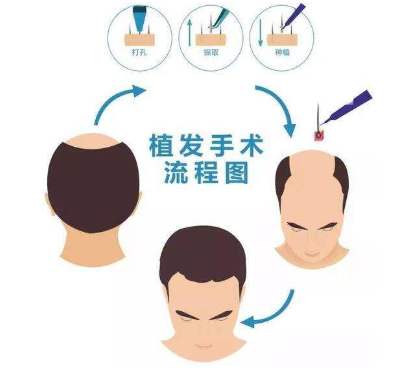 許多人關(guān)注的問題：種植的頭發(fā)是否會(huì)掉？