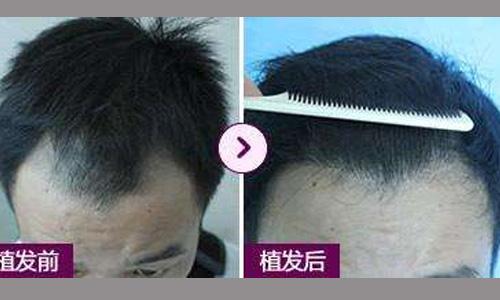 許多人關(guān)注的問題：種植的頭發(fā)是否會(huì)掉？