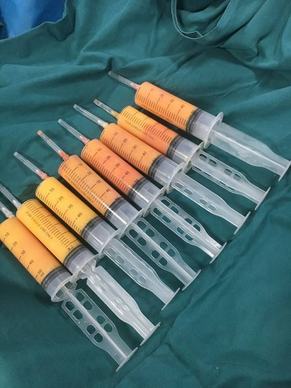 吸脂果怎么樣？可不可怕？就看這幾個方面