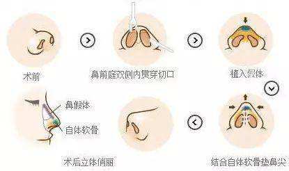 隆鼻手術(shù)如何做？詳盡步驟講解一下下