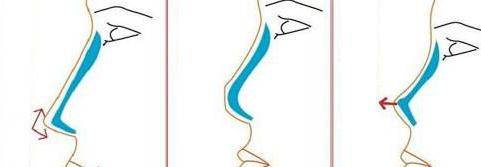 隆鼻手術(shù)如何做？詳盡步驟講解一下下