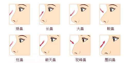 隆鼻手術(shù)如何做？詳盡步驟講解一下下