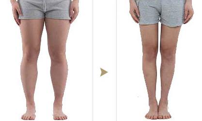 大腿吸脂手術需要多久？全部手術調(diào)節(jié)流程方法步驟