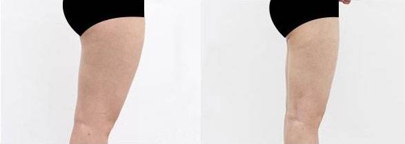 大腿吸脂手術需要多久？全部手術調(diào)節(jié)流程方法步驟