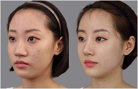 鼻頭縮小術(shù)價錢費用，醫(yī)院收費標準詳細信息