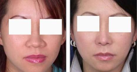 鼻頭縮小術(shù)價錢費用，醫(yī)院收費標準詳細信息