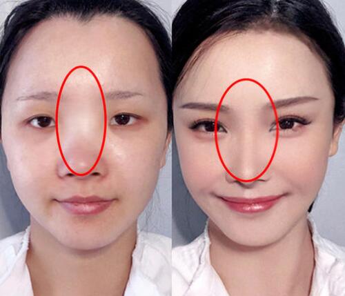 鼻頭縮小術(shù)價錢費用，醫(yī)院收費標準詳細信息