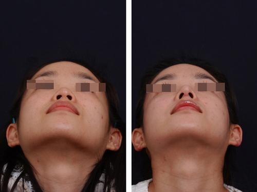 鼻頭縮小術(shù)價錢費用，醫(yī)院收費標準詳細信息