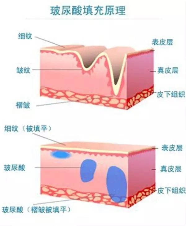 給你們瞧瞧玻尿酸注射的不良反應(yīng)，看完你還敢反復(fù)注射？