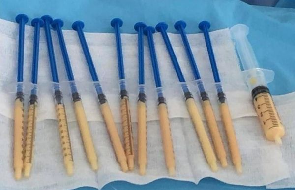 自體脂肪隆鼻手術(shù)的有關(guān)講解，長(zhǎng)知識(shí)了