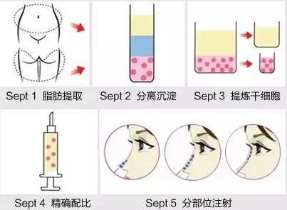 自體脂肪隆鼻手術(shù)的有關(guān)講解，長(zhǎng)知識(shí)了