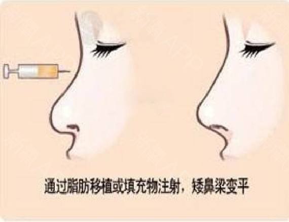 自體脂肪隆鼻手術(shù)的有關(guān)講解，長(zhǎng)知識(shí)了