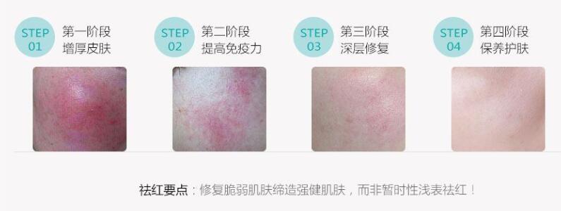 激光祛紅血絲沒問題可靠嗎？說真的絲毫都不喜歡“高原紅”