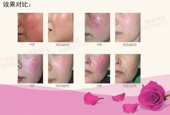 激光祛紅血絲沒問題可靠嗎？說真的絲毫都不喜歡“高原紅”