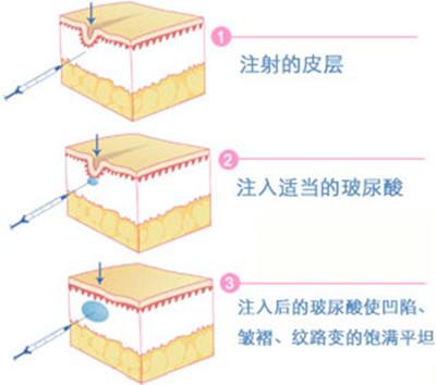 快30歲十分關(guān)注：注射玻尿酸除皺沒問題可靠嗎？猶豫不決該不該做