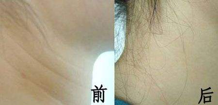 快30歲十分關(guān)注：注射玻尿酸除皺沒問題可靠嗎？猶豫不決該不該做