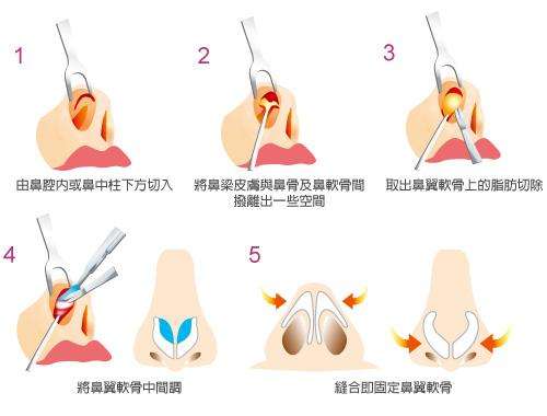 手術(shù)調(diào)節(jié)縮小鼻子的具體方法，技術(shù)總結(jié)