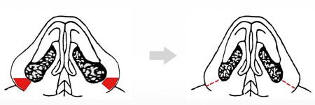 手術(shù)調(diào)節(jié)縮小鼻子的具體方法，技術(shù)總結(jié)