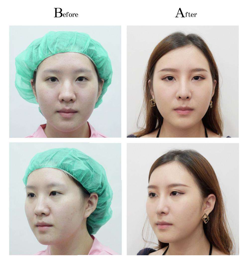 手術(shù)調(diào)節(jié)縮小鼻子的具體方法，技術(shù)總結(jié)