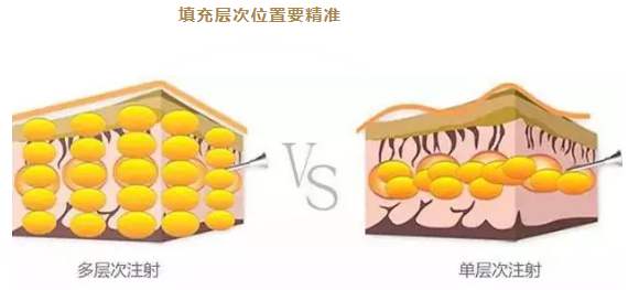 做了脂肪填充過后是否會發(fā)生腫塊、凸凹不平的狀況？