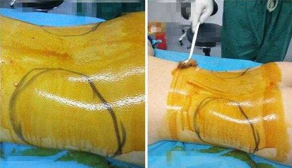 2019年腰部吸脂減肥價錢明細(xì)表，附吸脂圖