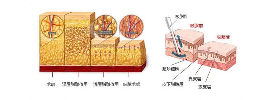 2019年腰部吸脂減肥價錢明細(xì)表，附吸脂圖