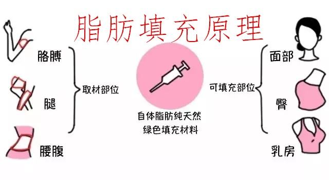 做了脂肪填充過后，是否會(huì)迅速就吸收掉？