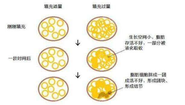 做了脂肪填充過后，是否會(huì)迅速就吸收掉？