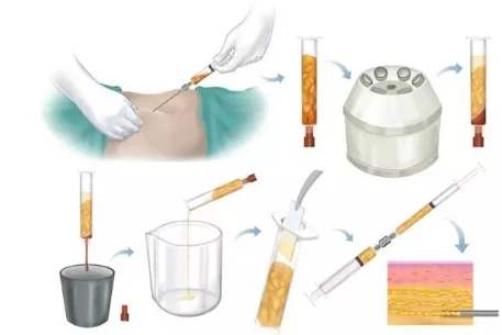 做了脂肪填充過后，是否會(huì)迅速就吸收掉？