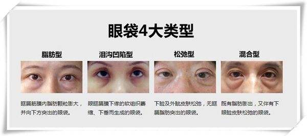 小編我陪你認(rèn)識眼袋抽脂術(shù)的基本原理，輕輕松松化解眼袋問題！