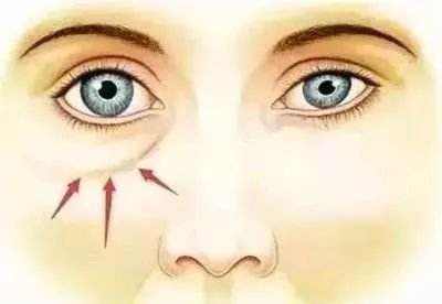 小編我陪你認(rèn)識眼袋抽脂術(shù)的基本原理，輕輕松松化解眼袋問題！