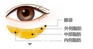 小編我陪你認(rèn)識眼袋抽脂術(shù)的基本原理，輕輕松松化解眼袋問題！