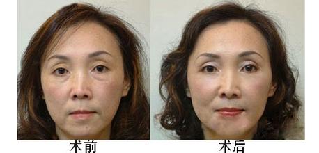 小編我陪你認(rèn)識眼袋抽脂術(shù)的基本原理，輕輕松松化解眼袋問題！