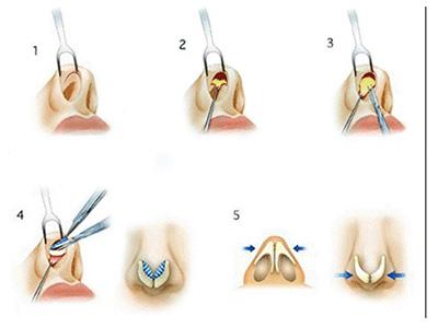 自體耳軟骨墊鼻尖價錢、后遺癥、整體果圖