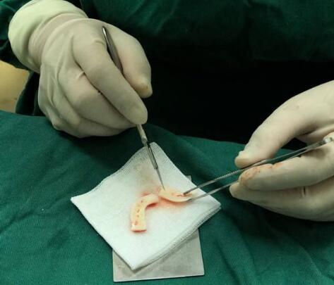 自體耳軟骨墊鼻尖價錢、后遺癥、整體果圖