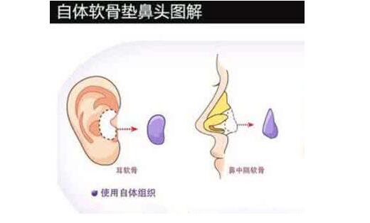 自體耳軟骨墊鼻尖價錢、后遺癥、整體果圖