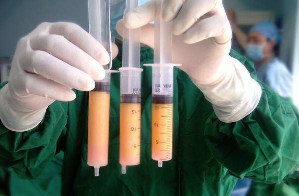 做抽脂手術(shù)失敗的幾率大不大？副作用有哪些？