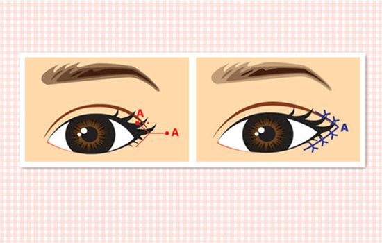 外眼角開大不令人滿意，能夠如何修復(fù)呢？